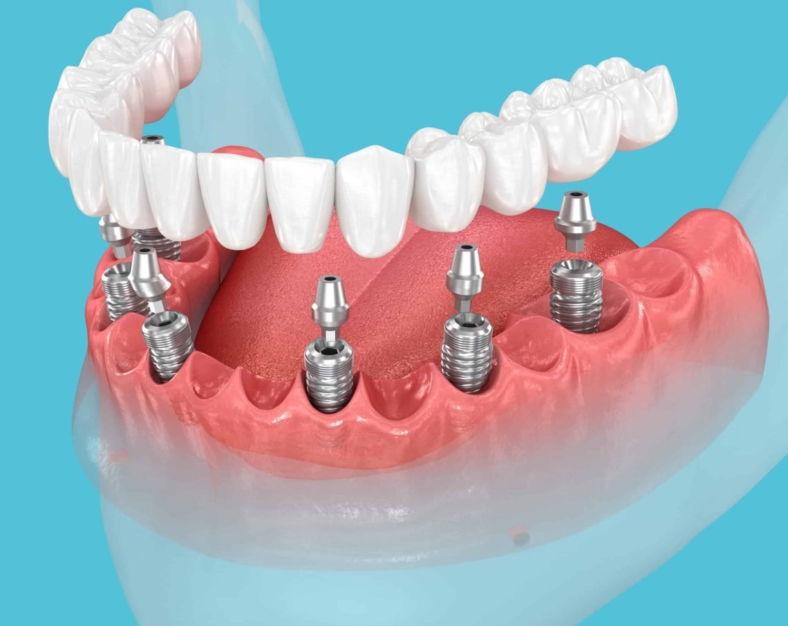 All-on-4 and All-on-6 dental implants in Addis Ababa Ethiopia