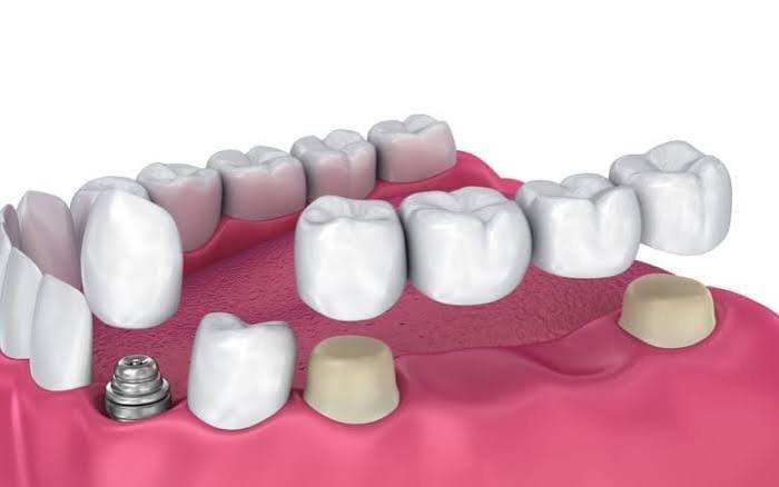 Dental crowns and bridges in Addis Ababa Ethiopia