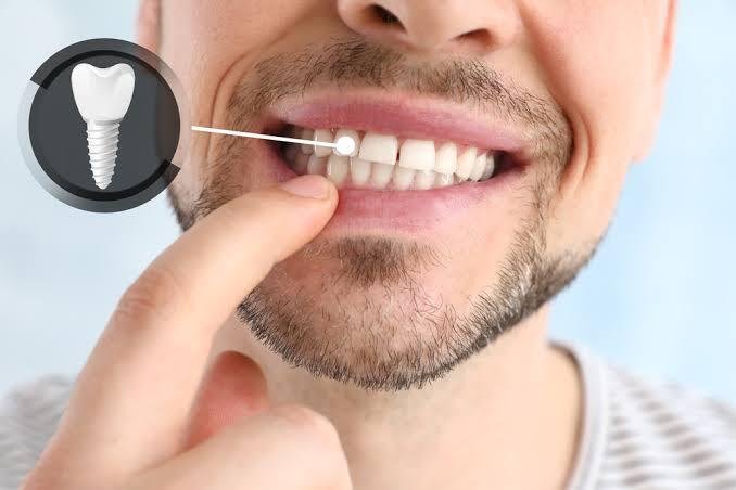Dental implant aftercare and maintenance in Addis Ababa Ethiopia