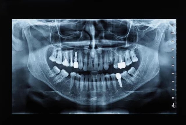 Dental implant CBCT planning in Addis Ababa Ethiopia