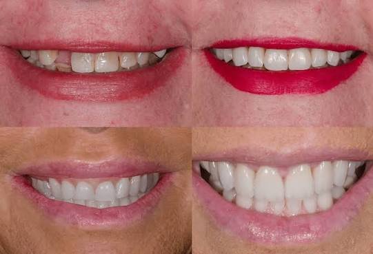 Dental veneers and smile design in Addis Ababa Ethiopia