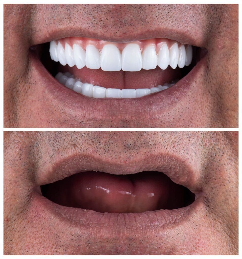 Full mouth dental implant restoration in Addis Ababa Ethiopia
