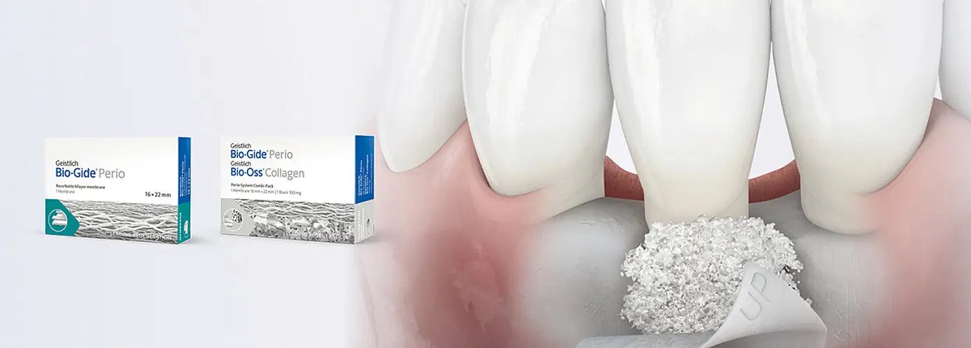 Geistlich bone regeneration materials for dental implants in Addis Ababa Ethiopia