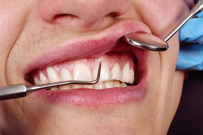 Gum treatment and periodontal care in Addis Ababa Ethiopia