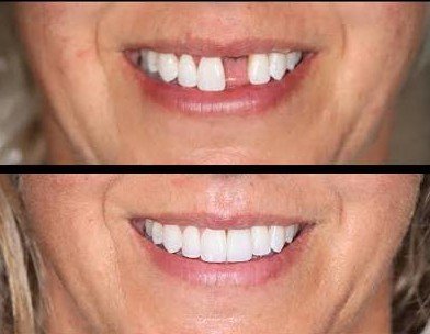 Missing teeth replacement with dental implants in Addis Ababa Ethiopia