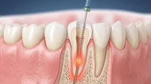 Root canal treatment in Addis Ababa Ethiopia